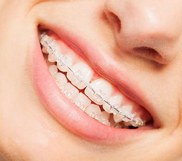 Middlesex Clear Braces
