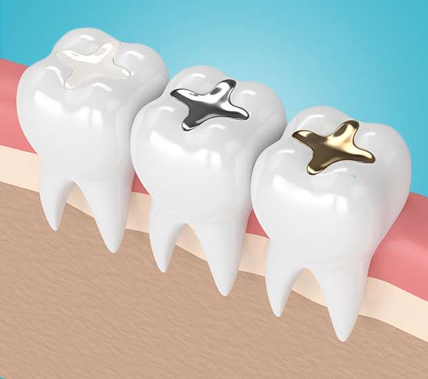 Middlesex Composite Fillings