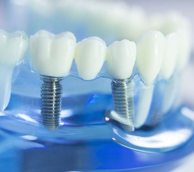 Middlesex Dental Implants