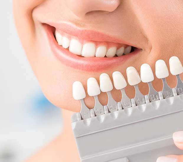Middlesex Dental Veneers and Dental Laminates