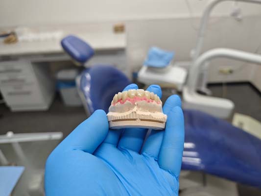What Is A Fixed Partial Denture?